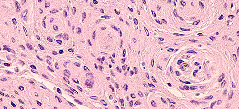 Brain biopsy histology (pathology) of a meningioma.