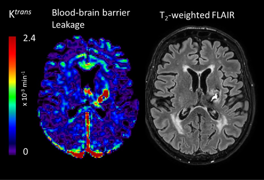Imaging the blood-brain barrier after stroke