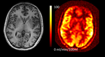 A standard clinical scan of the brain (left), and an MRI image (right).