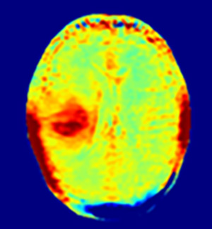 Amide Proton Transfer image.