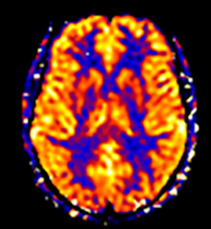 Arterial Spin Labelling image.