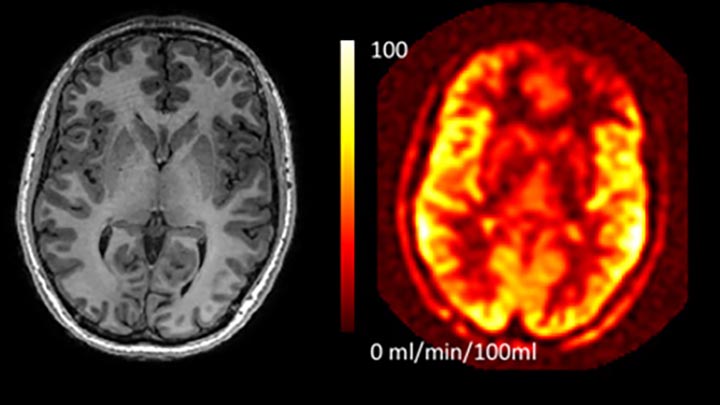 A standard clinical scan of the brain (left), and an MRI image (right).