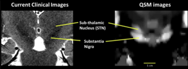 Quantitative Susceptibility Mapping (QSM) image.