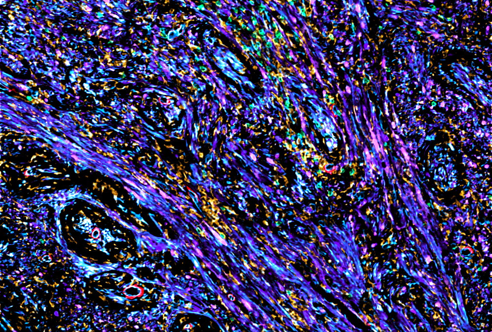 New funding for NF2 research
