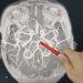 Study reveals key cause of brain blood flow restriction in vascular dementia